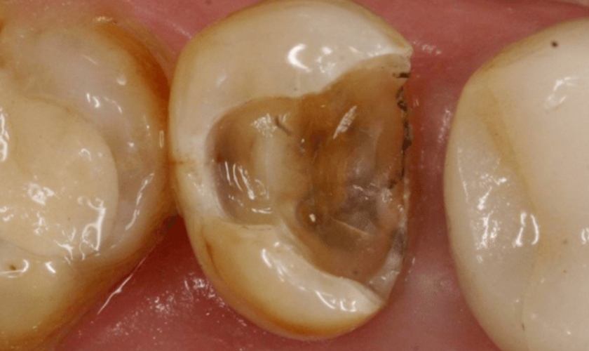 Bật mí những cách khắc phục răng hàm bị vỡ hiệu quả